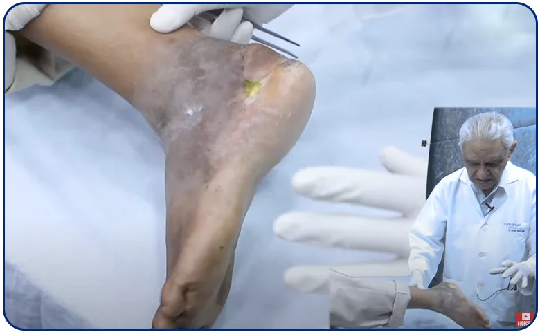 Non healing ulcers and the importance of undermining edges