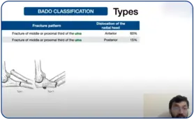 Monteggia Fractures by Dr Faheem Koteka